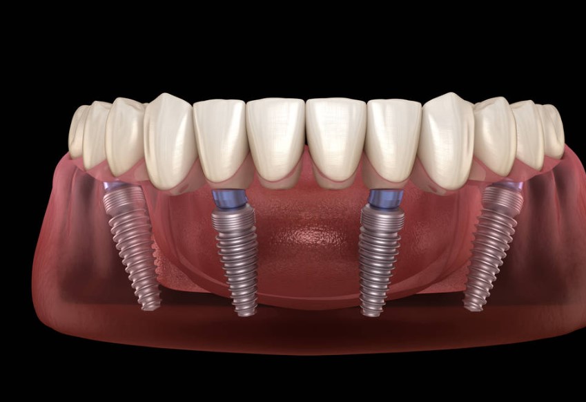 all on 4 dental implants